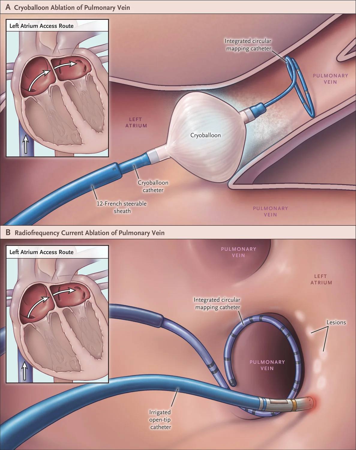 Cryoablation vs Radiofrequency Ablation for AFib