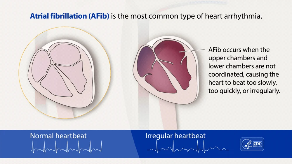 Cryoablation vs Radiofrequency Ablation for SVT