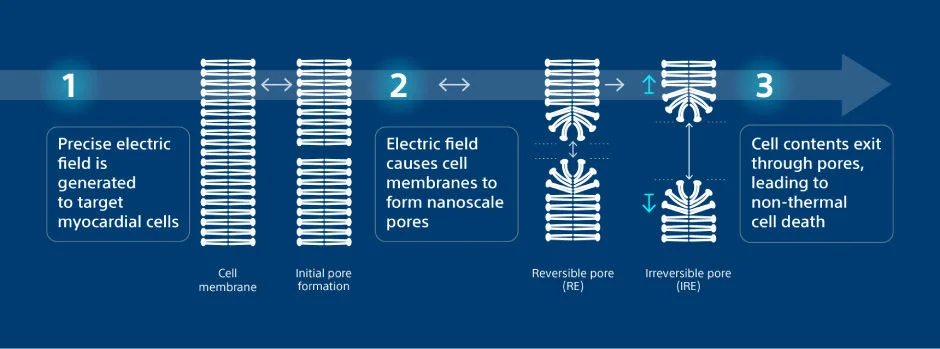 How Does Pulsed Field Ablation Work