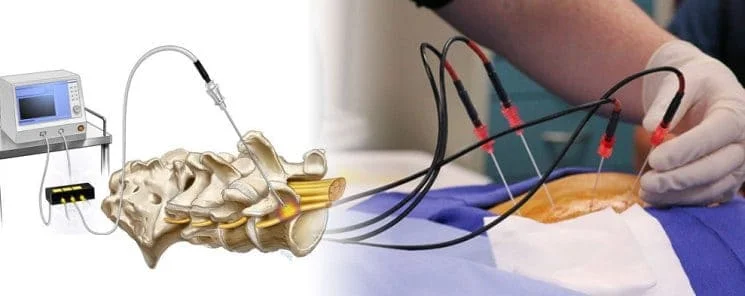 How Does Radiofrequency Ablation Work