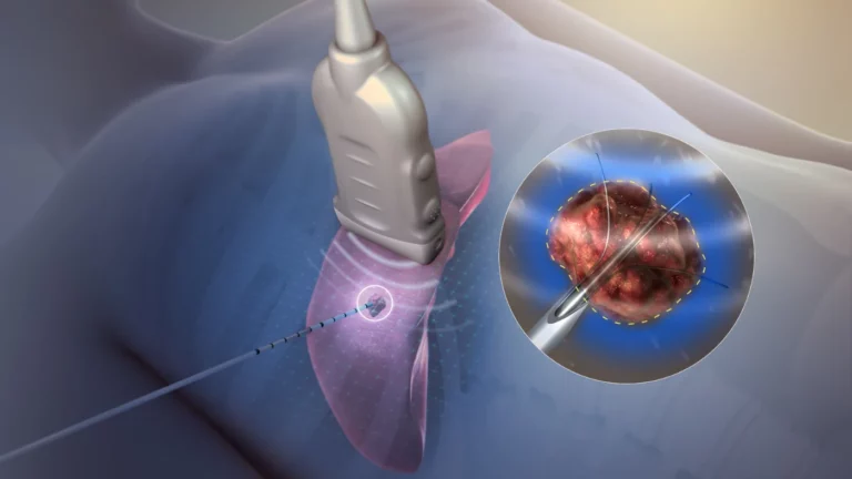 Pulsed Field Ablation vs Radiofrequency Ablation